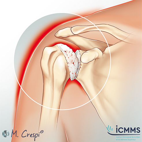 Arthrose de l'épaule, pathologie de l'épaule - ICMMS