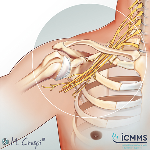 Atteinte nerveuse de l'épaule, pathologie de l'épaule - ICMMS