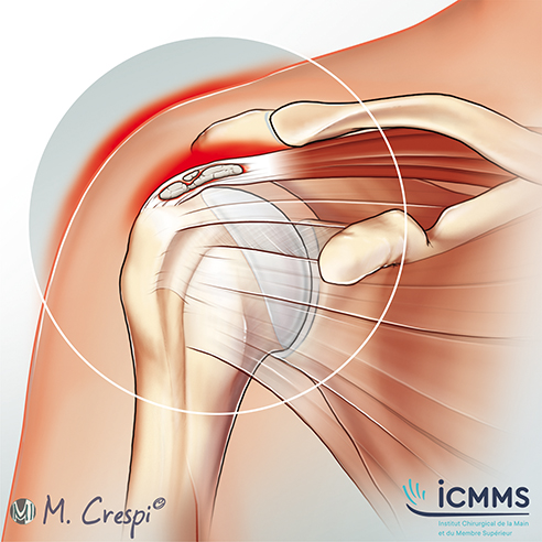 Calcification de l'épaule, pathologie de l'épaule - ICMMS