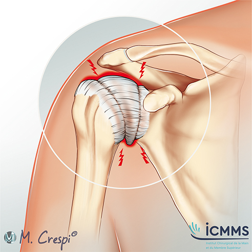 Capsulite rétractile, pathologie de l'épaule - ICMMS