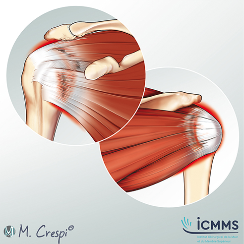 Coiffe des rotateurs, pathologie de l'épaule - ICMMS