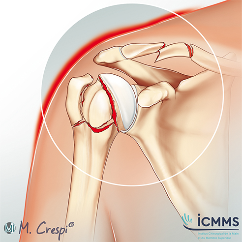 Illustration Fractures de l'épaule et de la clavicule, pathologie de l'épaule - ICMMS