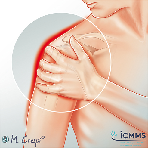 Illustration Infections osteo-articulaires de l’épaule, pathologie de l'épaule - ICMMS