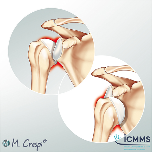 Illustration Instabilité de l’épaule, pathologie de l'épaule - ICMMS