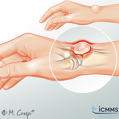 Illustration Kyste du poignet, pathologie du poignet - ICMMS