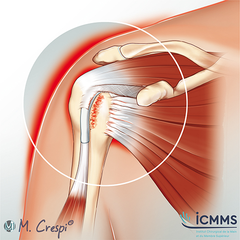 Illustration Lambeaux de l’épaule, pathologie de l'épaule - ICMMS