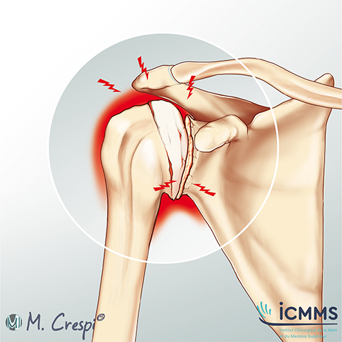 Illustration Ostéonécrose de l’épaule, pathologie de l'épaule - ICMMS