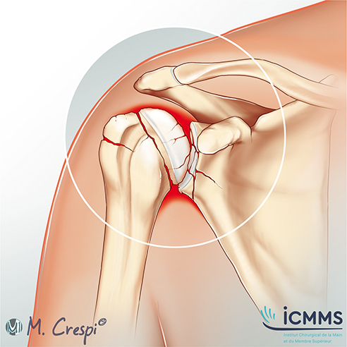 Illustration Ostéoporose de l’épaule, pathologie de l'épaule - ICMMS