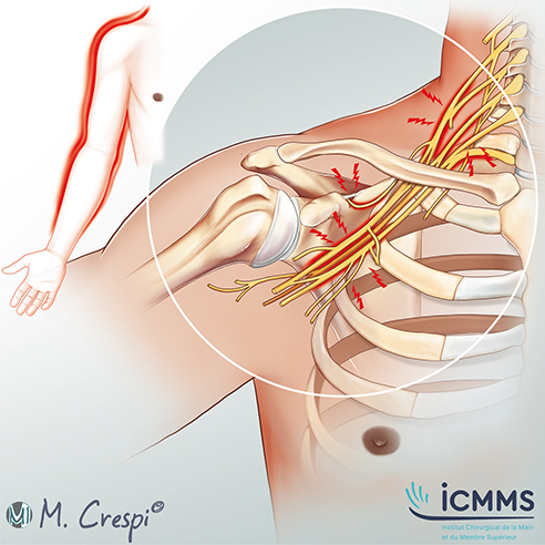 Illustration Paralysie du plexus brachial, pathologie de l'épaule - ICMMS