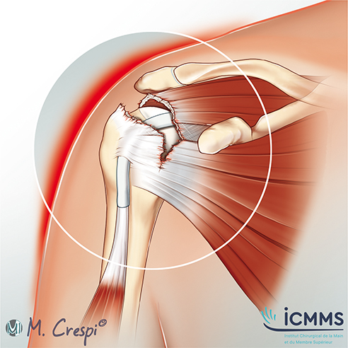 Illustration Rupture de la coiffe, pathologie de l'épaule - ICMMS