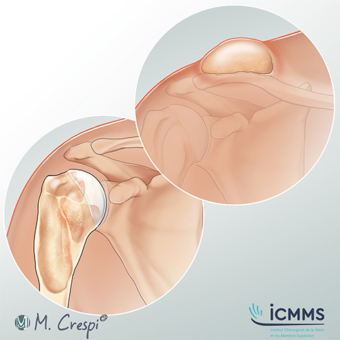 Illustration Tumeurs bénignes de l’épaule (lipomes, kystes), pathologie de l'épaule - ICMMS